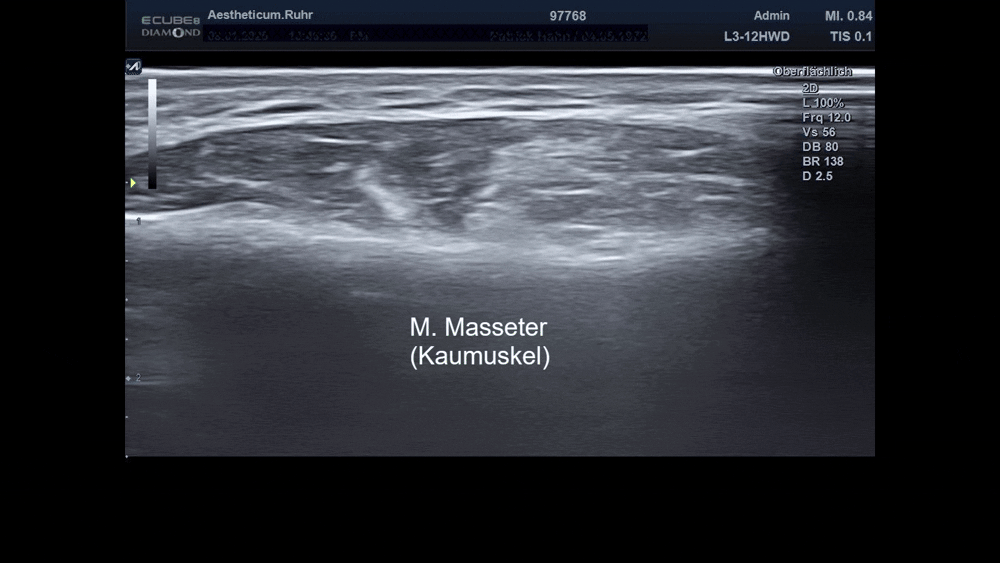 M.-Masseter